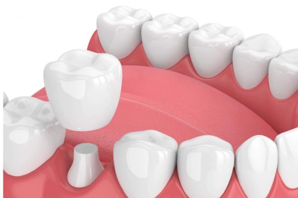 Bọc răng sứ có đau không - ảnh 1 Bọc răng sứ có đau không - ảnh 1