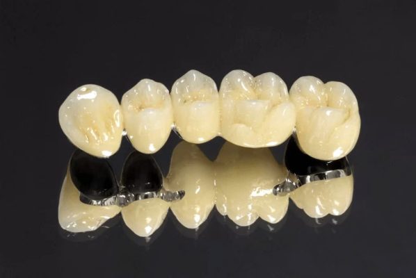bọc răng sứ loại nào tốt - ảnh 2 bọc răng sứ loại nào tốt - ảnh 2