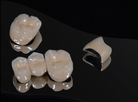 bọc răng sứ loại nào tốt - ảnh 3 bọc răng sứ loại nào tốt - ảnh 3