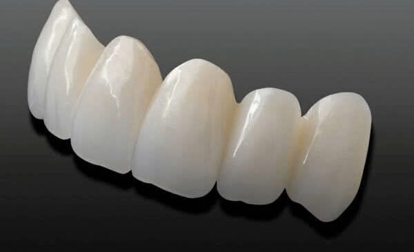 bọc răng sứ loại nào tốt - ảnh 5 bọc răng sứ loại nào tốt - ảnh 5