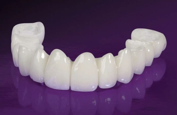 bọc răng sứ loại nào tốt - ảnh 6 bọc răng sứ loại nào tốt - ảnh 6