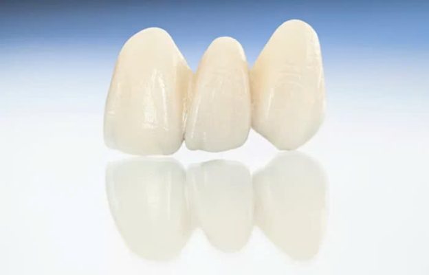 bọc răng sứ loại nào tốt - ảnh 7 bọc răng sứ loại nào tốt - ảnh 7