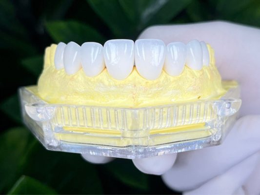 bọc răng sứ toàn hàm - ảnh 1 bọc răng sứ toàn hàm - ảnh 1
