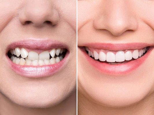 bọc răng sứ toàn hàm - ảnh 2 bọc răng sứ toàn hàm - ảnh 2