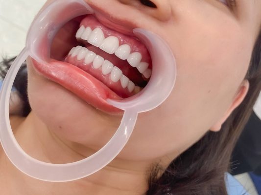 có nên bọc răng sứ không - ảnh 1 có nên bọc răng sứ không - ảnh 1