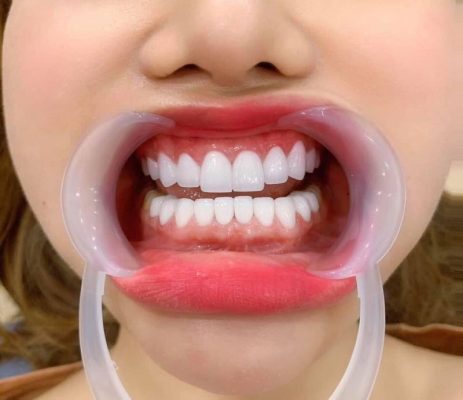 có nên bọc răng sứ không - ảnh 2 có nên bọc răng sứ không - ảnh 2