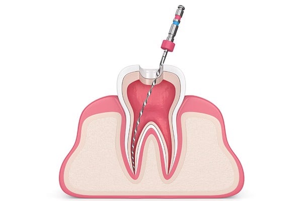 có nên bọc răng sứ không - ảnh 3 có nên bọc răng sứ không - ảnh 3
