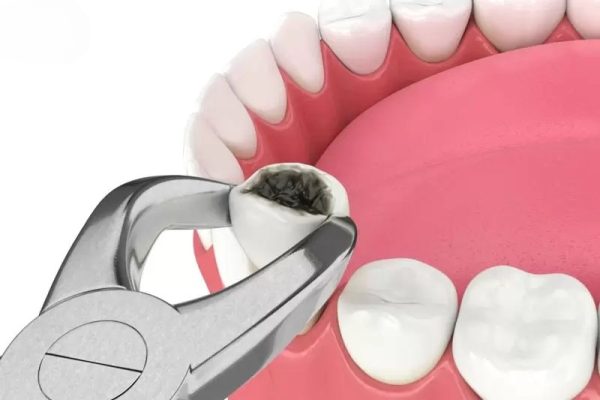 Nhổ răng bao lâu thì lành? - ảnh 1 Nhổ răng bao lâu thì lành? - ảnh 1