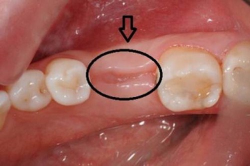 Nhổ răng bao lâu thì lành? - ảnh 2 Nhổ răng bao lâu thì lành? - ảnh 2