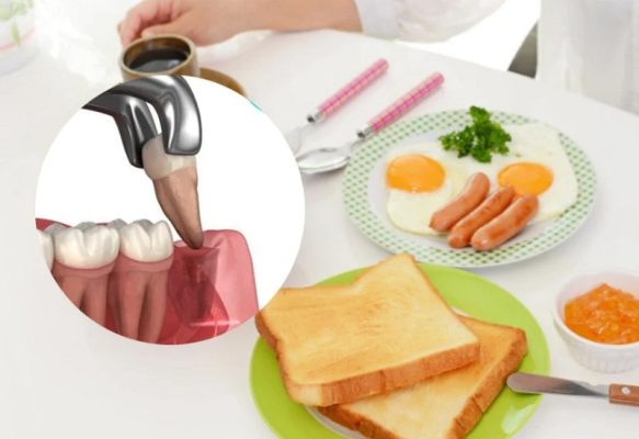 Nhổ răng bao lâu thì lành? - ảnh 3 Nhổ răng bao lâu thì lành? - ảnh 3