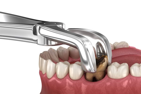 Nhổ răng có đau không? - ảnh 3 Nhổ răng có đau không? - ảnh 3