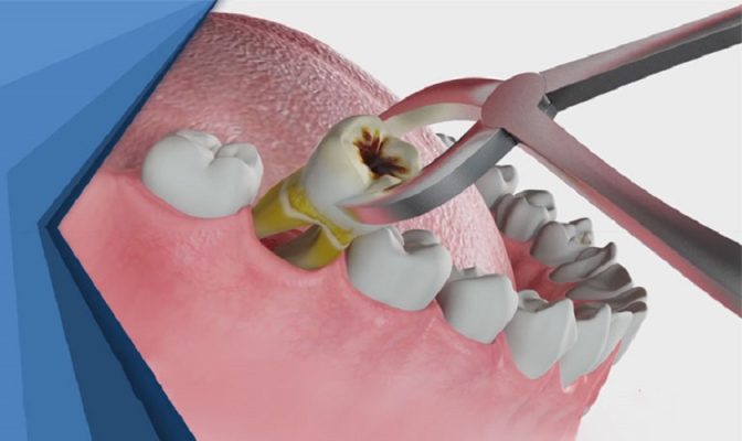 nhổ răng giá bao nhiêu - ảnh 1 nhổ răng giá bao nhiêu - ảnh 1