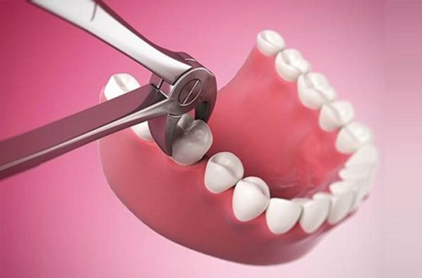 nhổ răng giá bao nhiêu - ảnh 2 nhổ răng giá bao nhiêu - ảnh 2