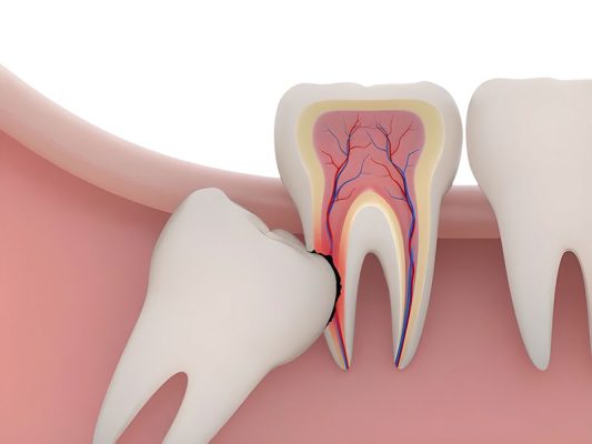 nhổ răng khôn - ảnh 1 nhổ răng khôn - ảnh 1