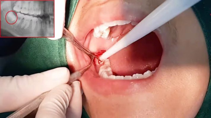 nhổ răng khôn - ảnh 2 nhổ răng khôn - ảnh 2