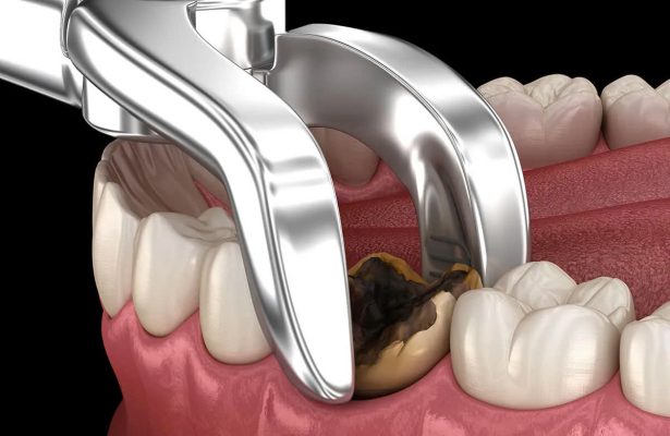 nhổ răng ở đâu - ảnh 1 nhổ răng ở đâu - ảnh 1
