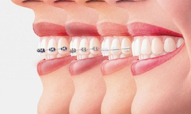 Niềng răng giá bao nhiêu - ảnh 1 Niềng răng giá bao nhiêu - ảnh 1