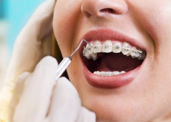 Niềng răng có đau không? - ảnh 1 Niềng răng có đau không? - ảnh 1