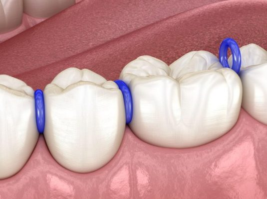 Niềng răng có đau không? - ảnh 2 Niềng răng có đau không? - ảnh 2