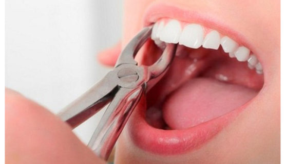 Niềng răng có đau không? - ảnh 3 Niềng răng có đau không? - ảnh 3