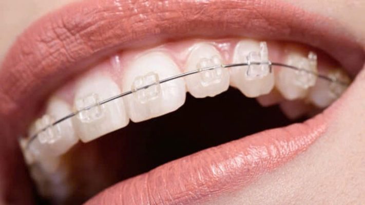 Niềng răng có đau không? - ảnh 5 Niềng răng có đau không? - ảnh 5