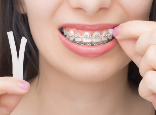 Niềng răng có đau không? - ảnh 9 Niềng răng có đau không? - ảnh 9