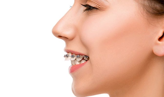Niềng răng hô - ảnh 2 Niềng răng hô - ảnh 2