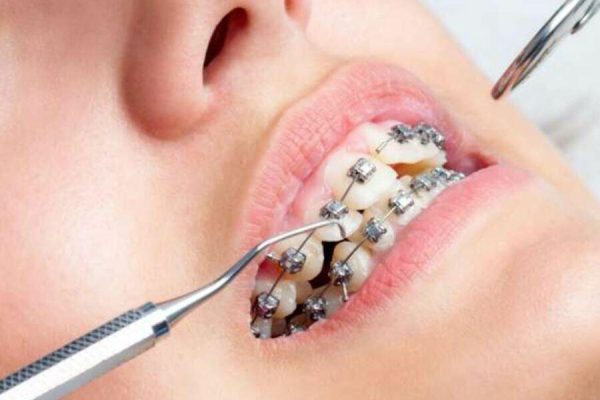 Niềng răng hô - ảnh 3 Niềng răng hô - ảnh 3