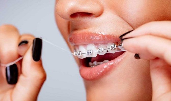 Niềng răng hô - ảnh 4 Niềng răng hô - ảnh 4