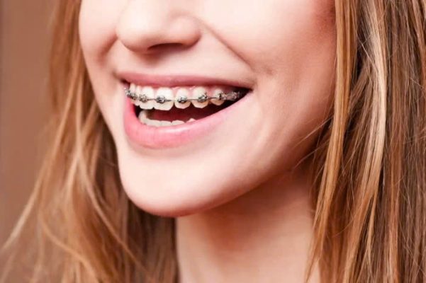 Niềng răng kim loại - ảnh 2 Niềng răng kim loại - ảnh 2
