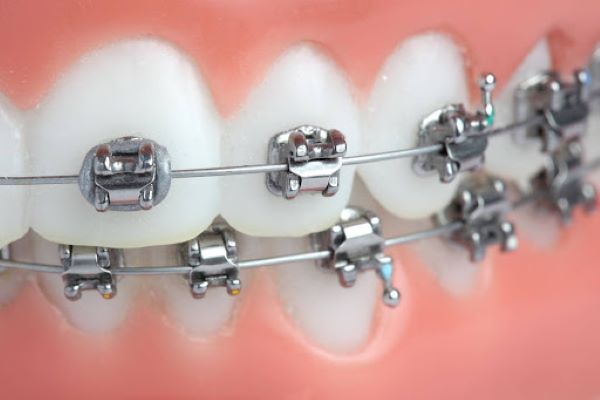 Niềng răng kim loại - ảnh 3 Niềng răng kim loại - ảnh 3