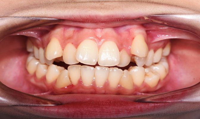 niềng răng lệch - ảnh 1 niềng răng lệch - ảnh 1