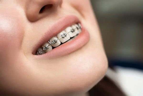 niềng răng lệch - ảnh 2 niềng răng lệch - ảnh 2
