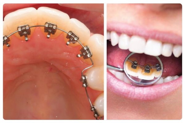 niềng răng lệch - ảnh 4 niềng răng lệch - ảnh 4