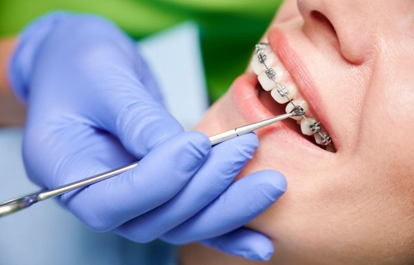 niềng răng lệch - ảnh 6 niềng răng lệch - ảnh 6
