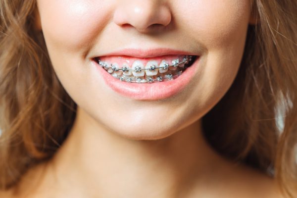 Niềng răng loại nào tốt? - ảnh 1 Niềng răng loại nào tốt? - ảnh 1