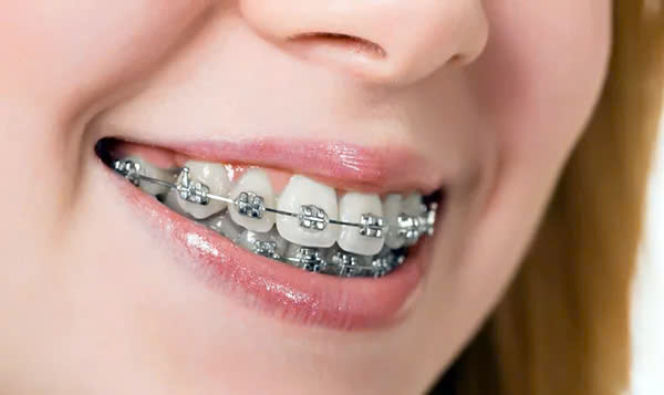Niềng răng loại nào tốt? - ảnh 2 Niềng răng loại nào tốt? - ảnh 2