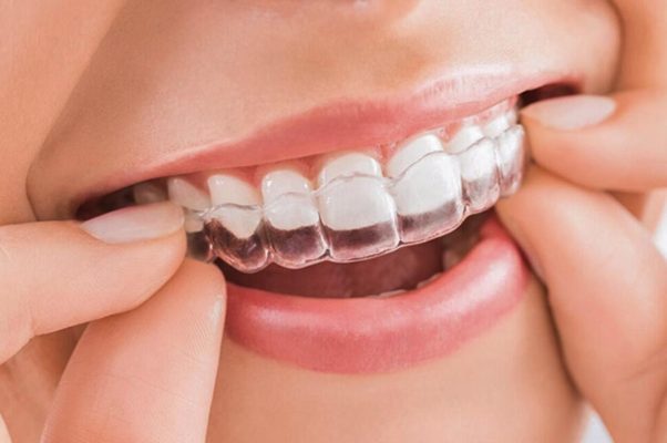 Niềng răng loại nào tốt? - ảnh 3 Niềng răng loại nào tốt? - ảnh 3