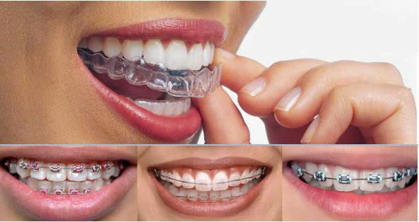 Niềng răng loại nào tốt? - ảnh 4 Niềng răng loại nào tốt? - ảnh 4
