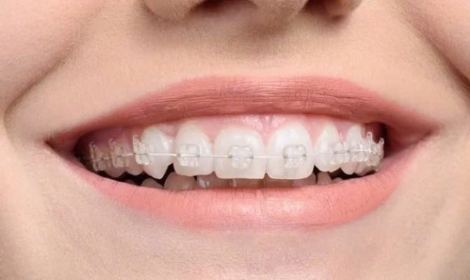 niềng răng mắc cài sứ - ảnh 1 niềng răng mắc cài sứ - ảnh 1