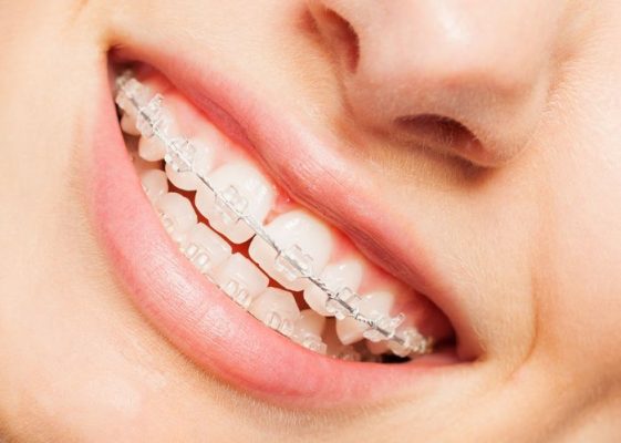 niềng răng mắc cài sứ - ảnh 2 niềng răng mắc cài sứ - ảnh 2