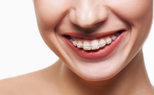 niềng răng mắc cài sứ - ảnh 3 niềng răng mắc cài sứ - ảnh 3
