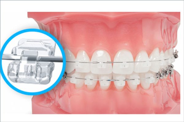 niềng răng mắc cài sứ - ảnh 4 niềng răng mắc cài sứ - ảnh 4