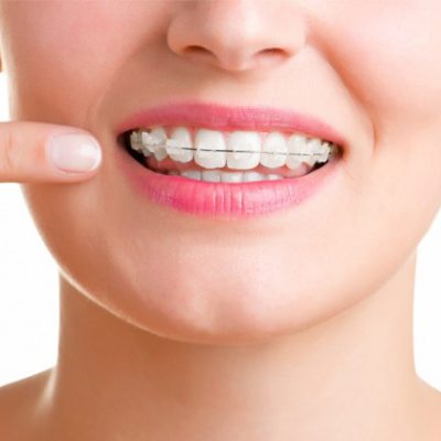 niềng răng mắc cài sứ - ảnh 5 niềng răng mắc cài sứ - ảnh 5