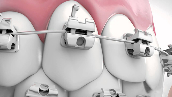 niềng răng mắc cài tự động - ảnh 1 niềng răng mắc cài tự động - ảnh 1