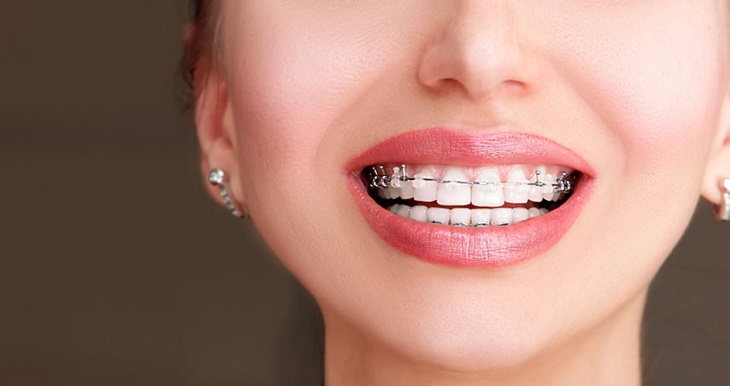 niềng răng mắc cài tự động - ảnh 3 niềng răng mắc cài tự động - ảnh 3