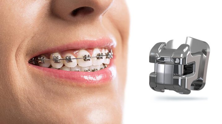 niềng răng mắc cài tự động - ảnh 4 niềng răng mắc cài tự động - ảnh 4