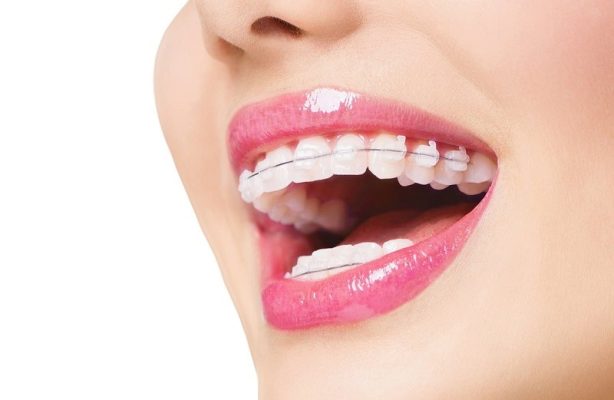 niềng răng ở đâu tốt? - ảnh 1 niềng răng ở đâu tốt? - ảnh 1