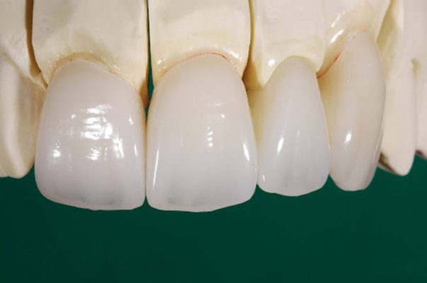 Răng sứ Ceramill - ảnh 4 Răng sứ Ceramill - ảnh 4