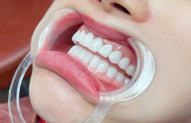 Răng sứ Orodent - ảnh 3 Răng sứ Orodent - ảnh 3
